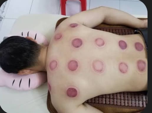 Cạo gió ,giác hơi - 2